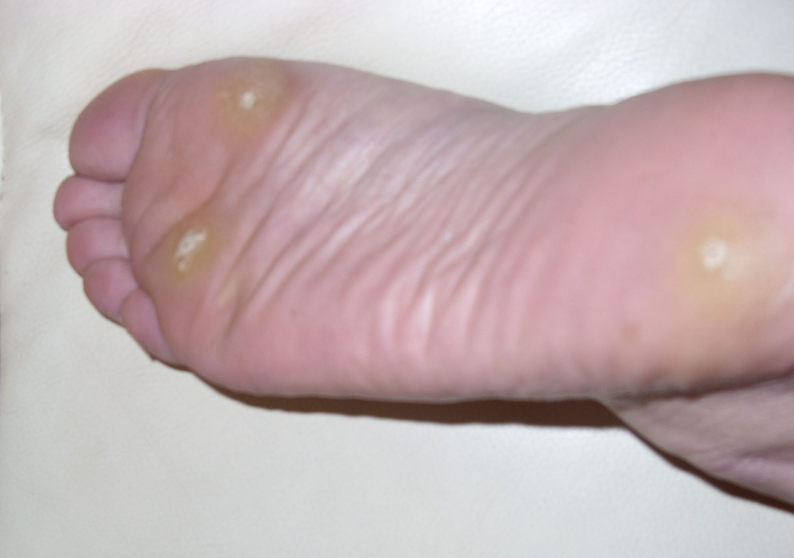 Myths and Facts About Plantar Warts