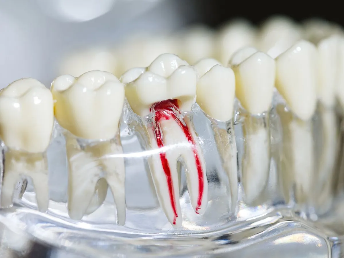 Signs You Might Need a Root Canal