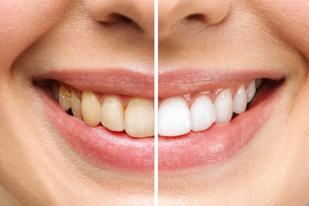 When Should I Get Teeth Whitening?