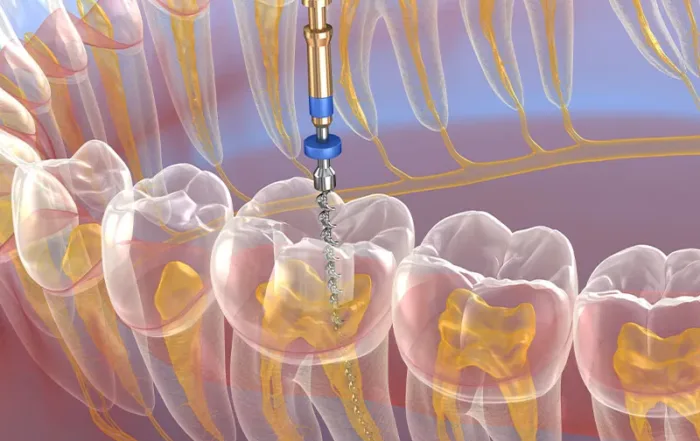 What Patients Should Know About Endodontic Implants