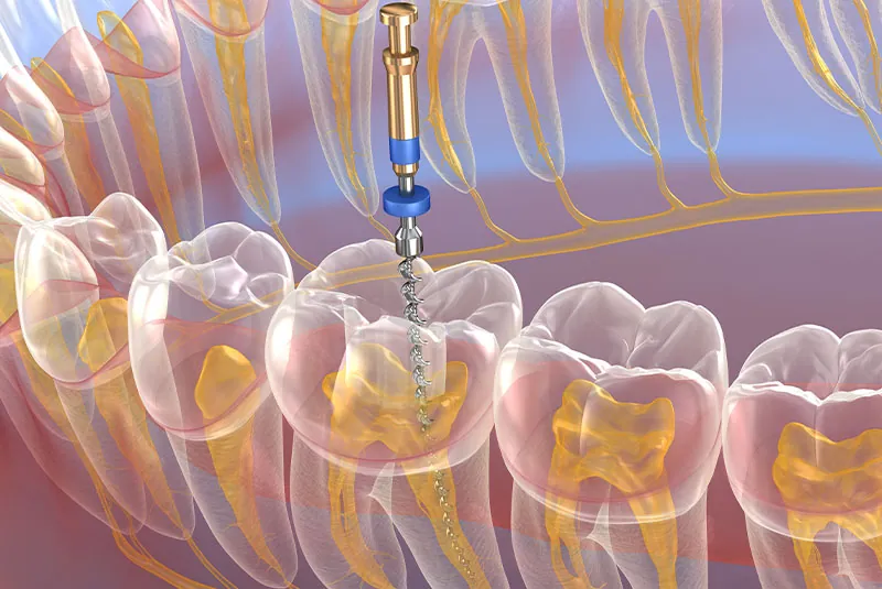 What Patients Should Know About Endodontic Implants