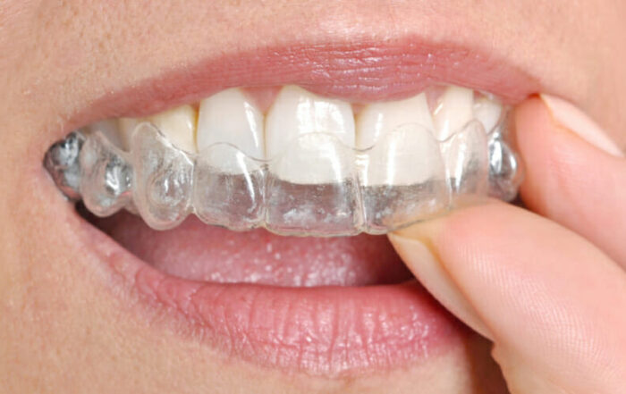 How Clear Aligners Work