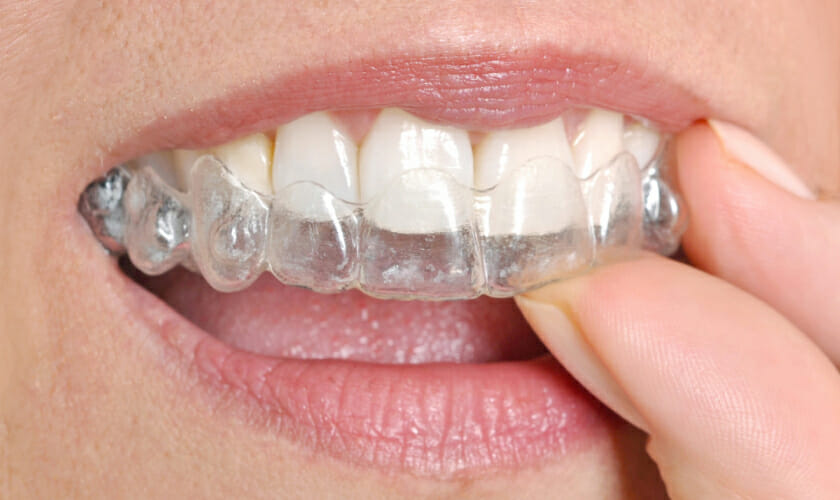 How Clear Aligners Work