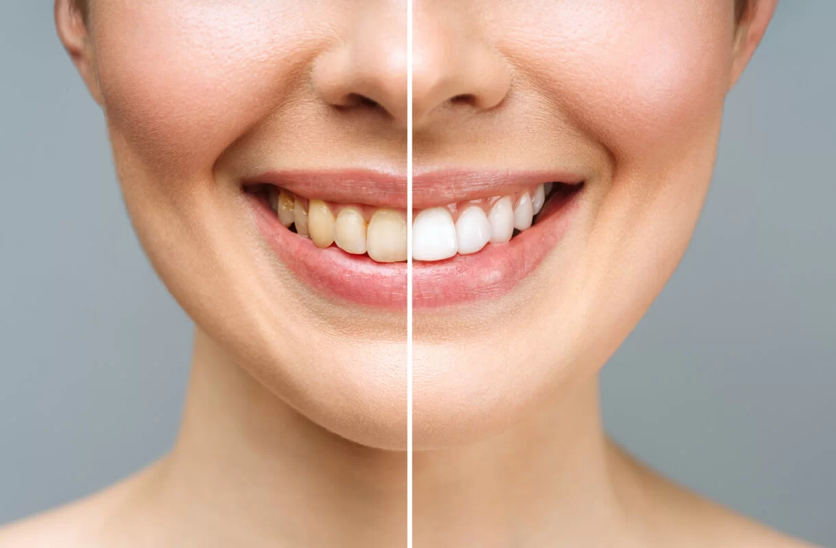 Understanding the Different Areas of Cosmetic Dentistry