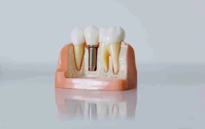 What You Need to Know About Dental Implants