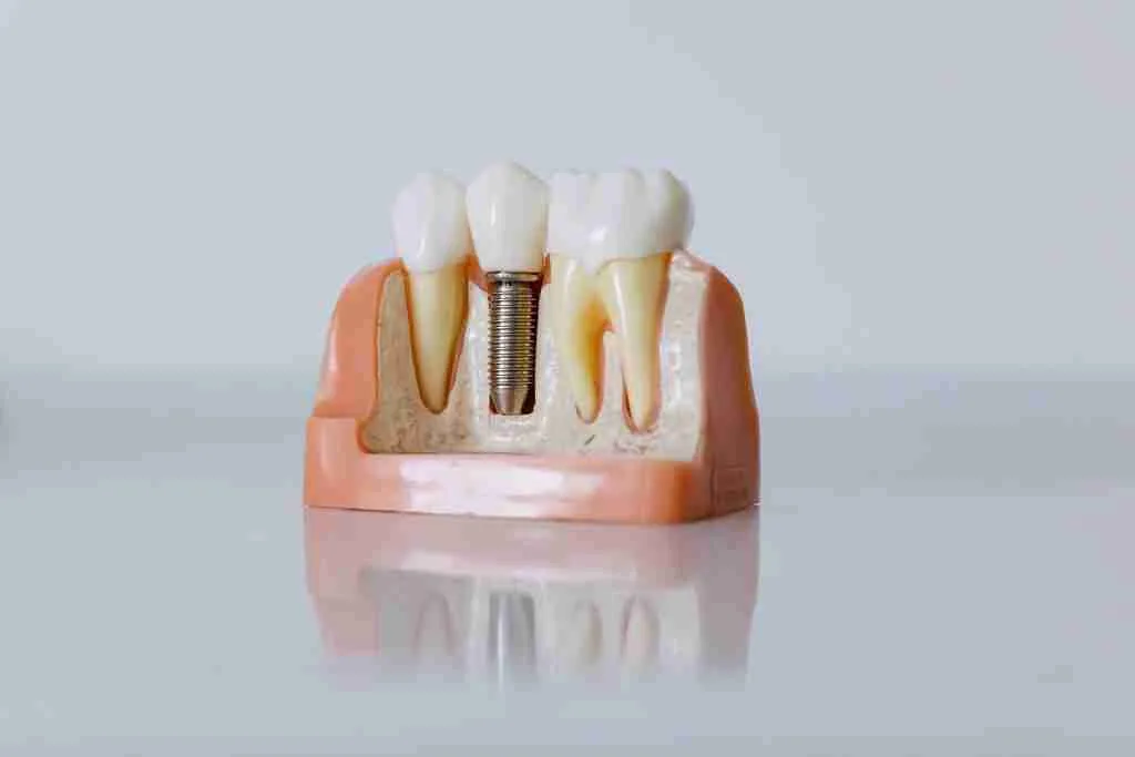 What You Need to Know About Dental Implants