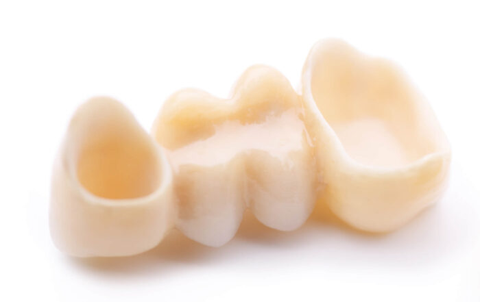 When to Consider a Dental Bridge