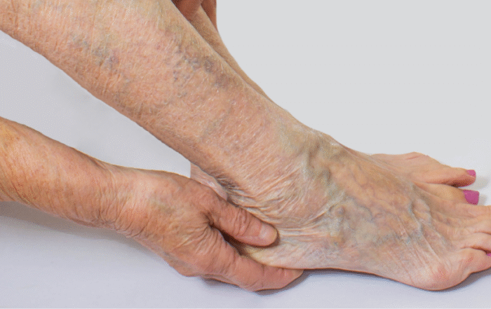 4 Remedies for Varicose Veins Relief