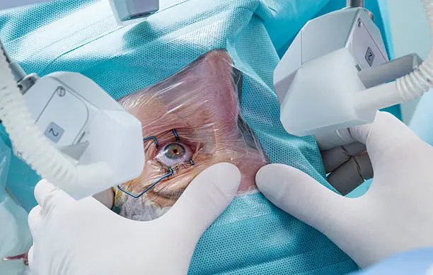 Can Laser Cataract Surgery Help With Astigmatism?