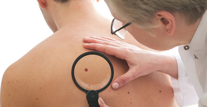 Exploring Treatments for Skin Cancer