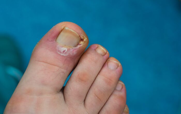 How Podiatrists Diagnose and Treat Ingrown Toenails