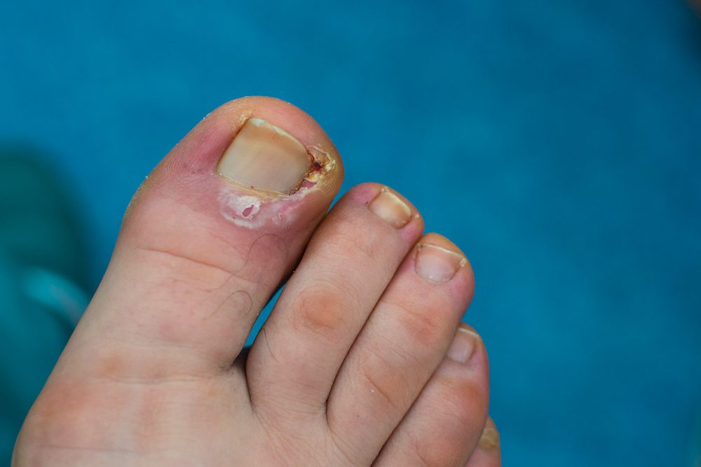 How Podiatrists Diagnose and Treat Ingrown Toenails How Podiatrists Diagnose and Treat Ingrown Toenails