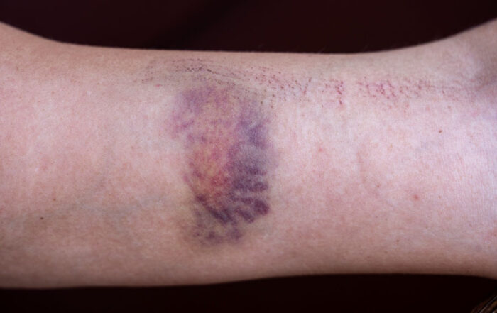 Identifying and Treating Infected Wounds