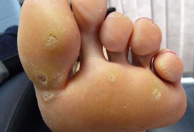 Recognizing Infected Wounds and How To Treat Them