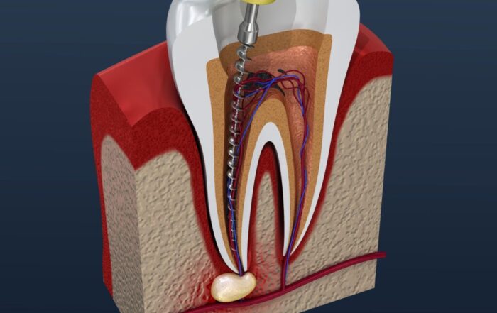 The Role of an Endodontic Specialist in Dental Care