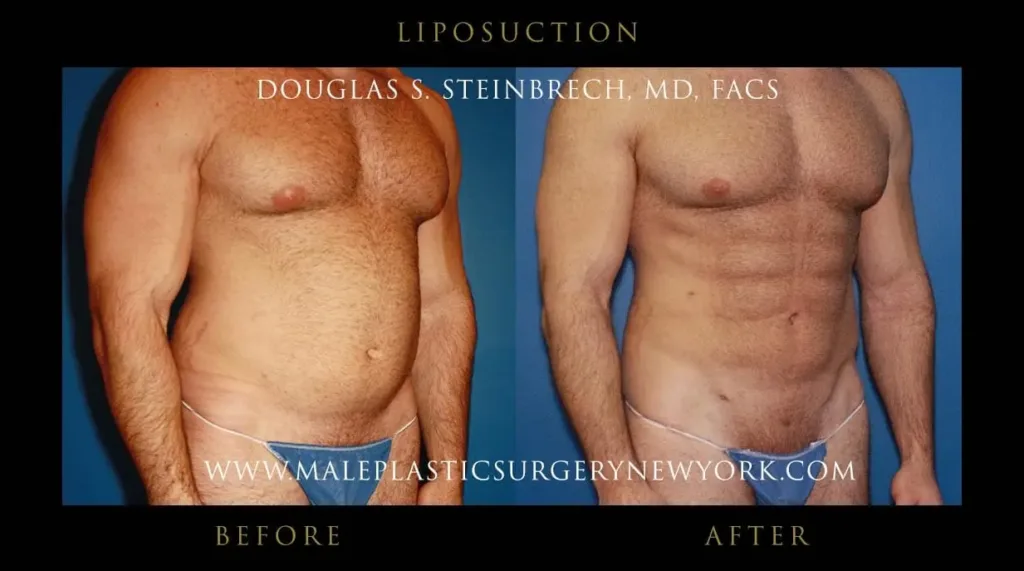 What to Know About Liposuction for Men