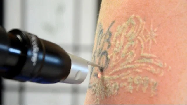 The Safety and Efficacy of Laser Tattoo Removal
