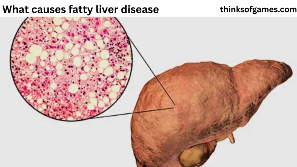 what causes fatty liver disease​