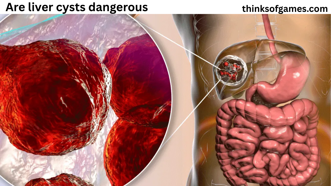 are liver cysts dangerous